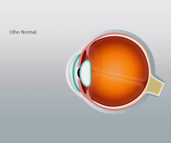 O que é o astigmatismo?
