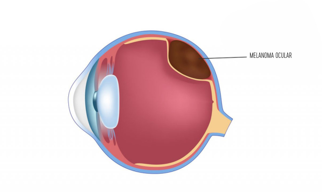 Melanoma Ocular -um tipo de cancro que afeta a visão