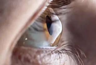 Lentes de contacto para queratocone: tipos, adaptação e resultados esperados Lentes de contacto para queratocone