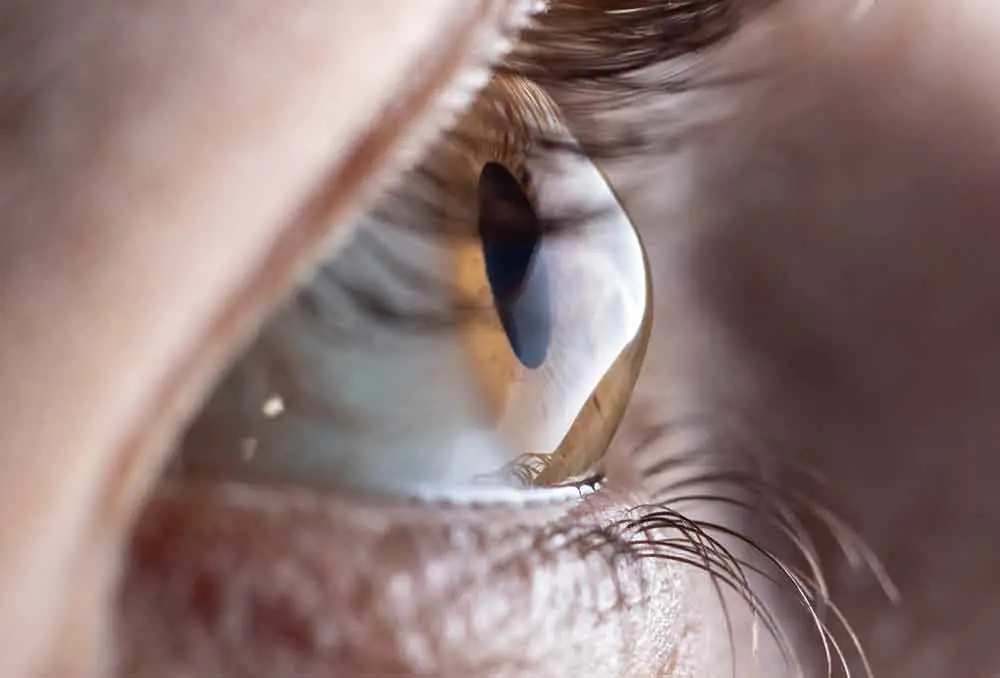 Lentes de contacto para queratocone