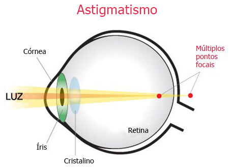 Fadiga, dores de cabeça, estrabismo e desconforto ocular podem indicar um leve grau de astigmatismo
