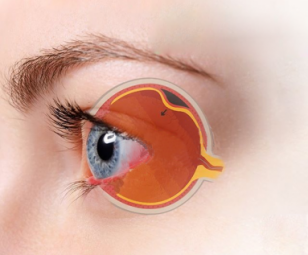 Os sintomas do descolamento de retina