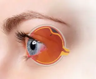 Os sintomas do descolamento de retina Os sintomas do descolamento de retina