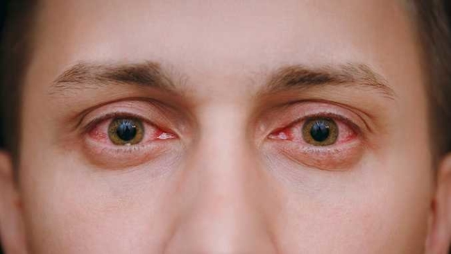 Olhos vermelhos: causas e tratamentos