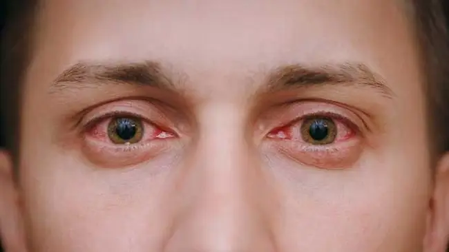 Olhos vermelhos: causas e tratamentos
