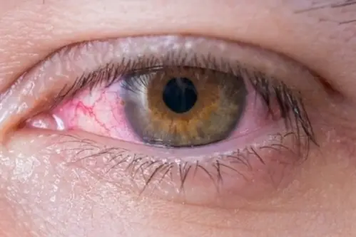 Vermelhidão ocular Vermelhidão ocular