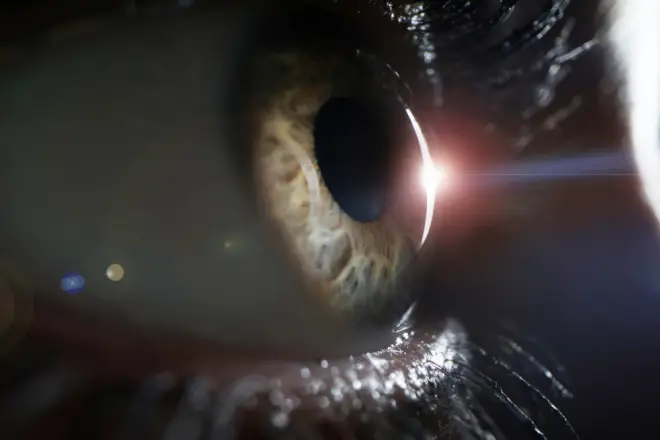 Tratamento com Cirugia Lasik Tratamento com Cirurgia Lasik