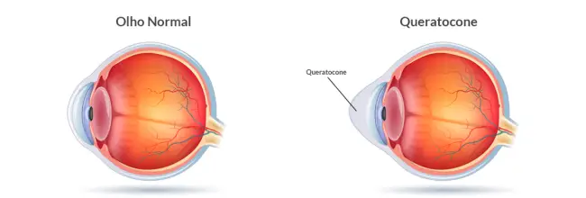 O que é queratocone?