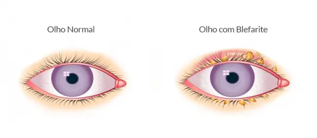 Métodos de higiene palpebral