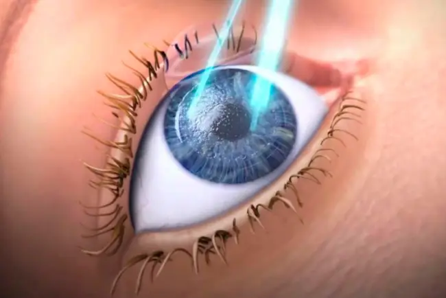 LASIK (laser in-situ keratomileusis)