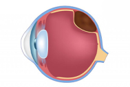Melanoma Ocular: o que é, sintomas e tratamentos
