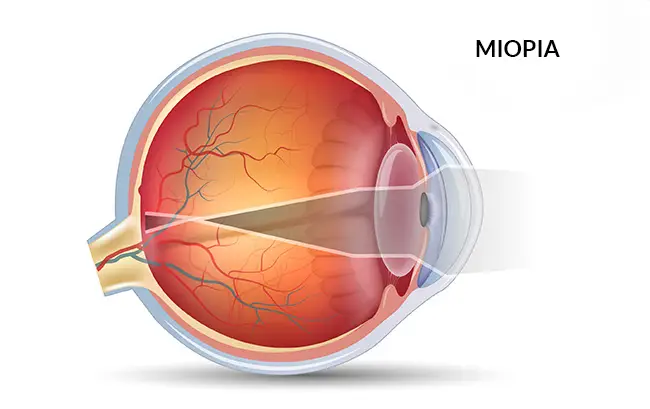 Existe cura definitiva para a miopia?