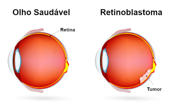 Síntomas da retinoblastoma