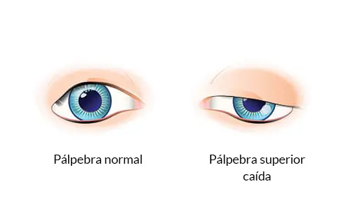 Ptose palpebral