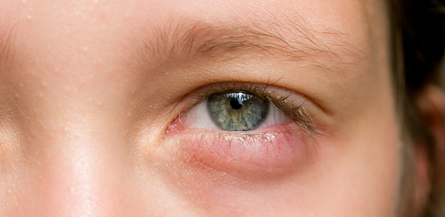 Infecções Bacterianas nos Olhos