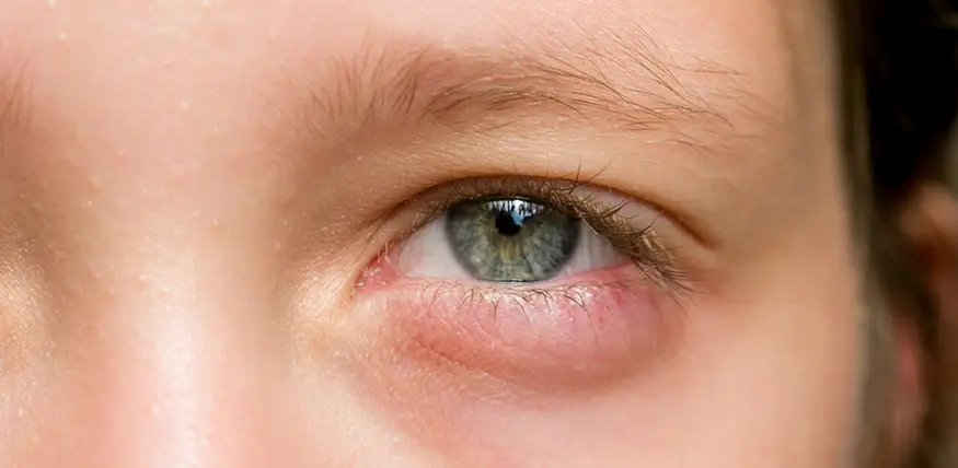 Infecções Bacterianas nos Olhos Infecções Bacterianas nos Olhos