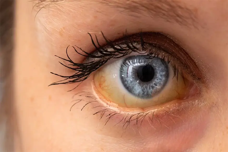 Olhos amarelos Olhos amarelos