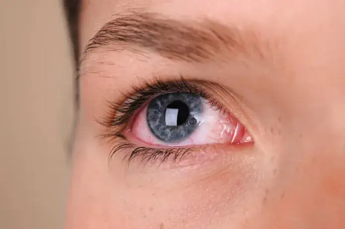Infecciones Oculares Comunes Infecciones Oculares Comunes