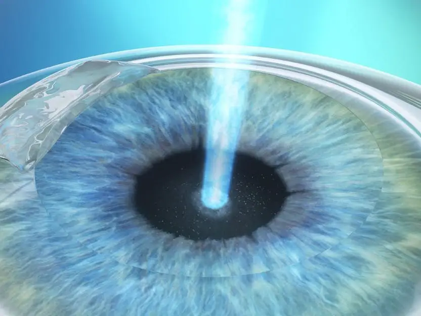 Cirurgias a laser LASIK, LASEK e PRK Cirurgias a laser LASIK, LASEK e PRK