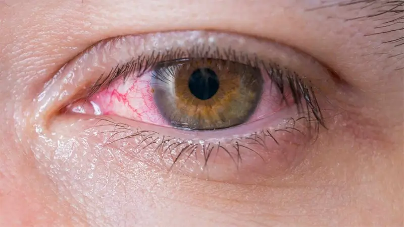 Vermelhidão ocular Vermelhidão ocular