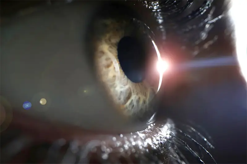 Tratamento com Cirurgia Lasik Tratamento com Cirurgia Lasik