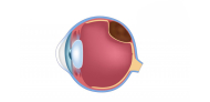 Melanoma Ocular: o que é, sintomas e tratamentos