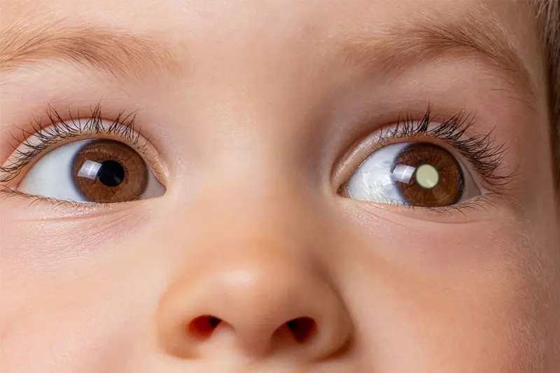Retinoblastoma: o que é? Retinoblastoma: o que é?