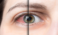Infeções oculares causados por estreptococos
