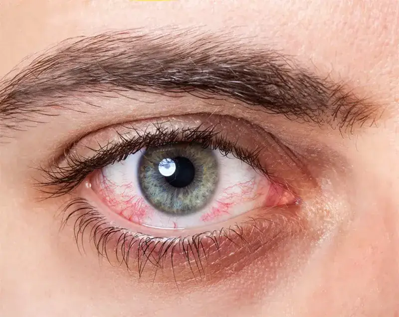 Como evitar a secura ocular
